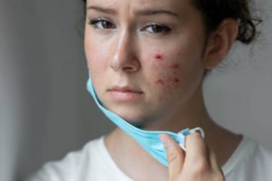 is rosacea an autoimmune disease